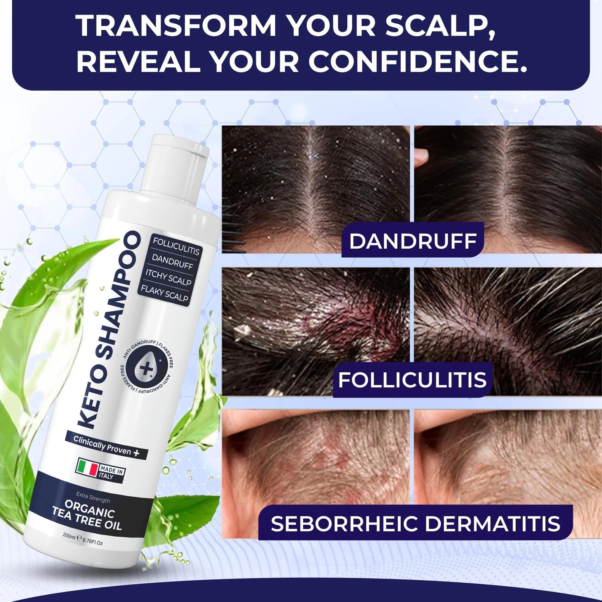 Scalp Psoriasis Shampoo Flakes anti Dandruff Itchy Scalp Treatment for Seborrheic Dermatitis & Folliculitis anti Fungal Medicated Solution for Itchy Flaky & Dry Hairs